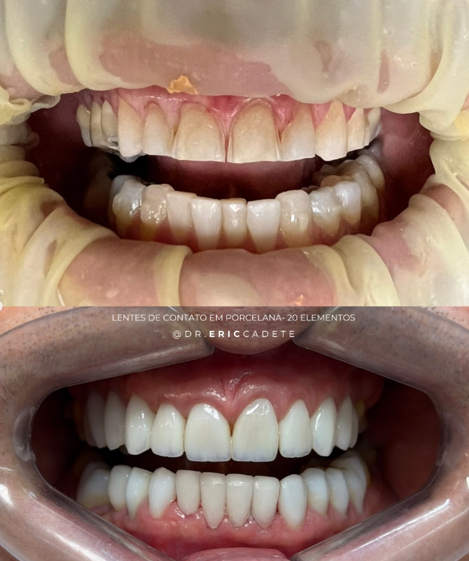 Antes e depois — lentes de contato em porcelana, 20 elementos